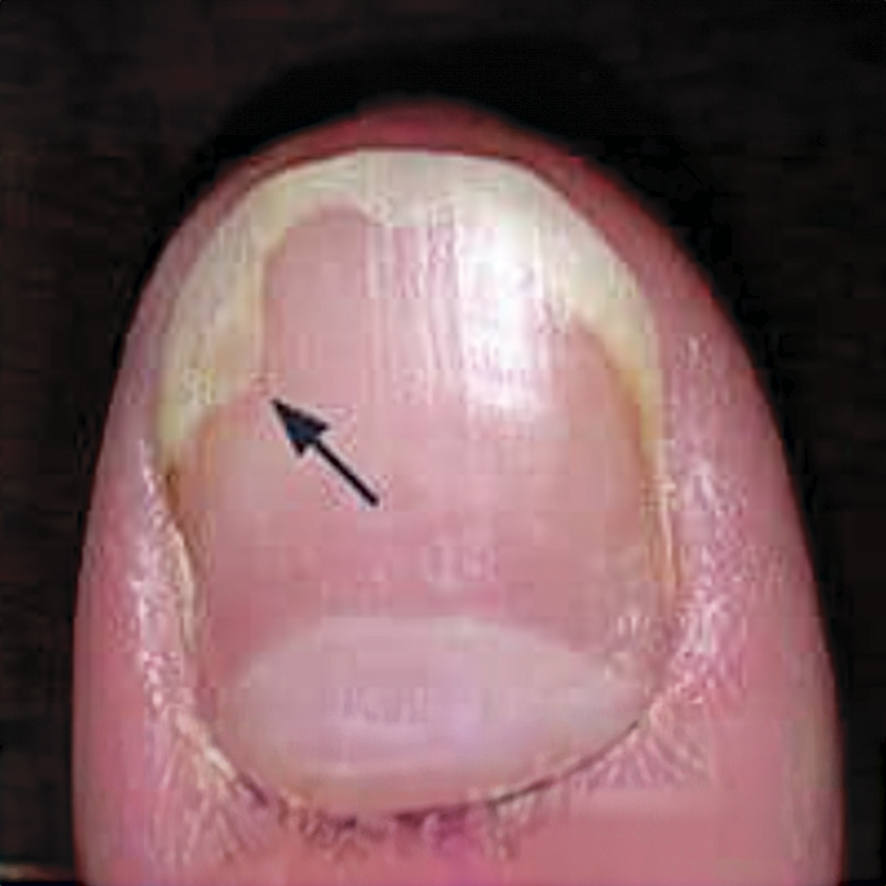 Les dangers du décollement des ongles (onycholyse) et comment l’éviter — free download